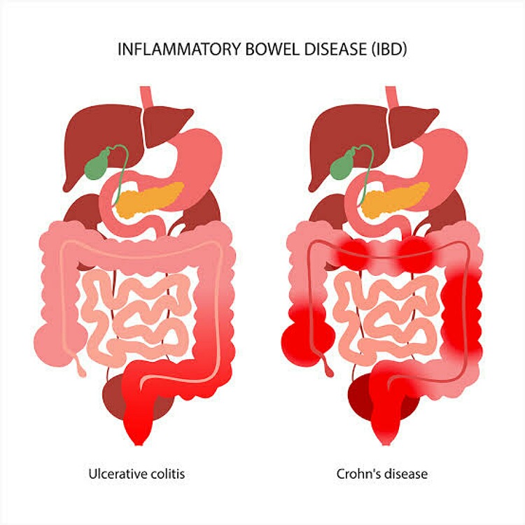 Vị trí viêm của bệnh UC và Crohn